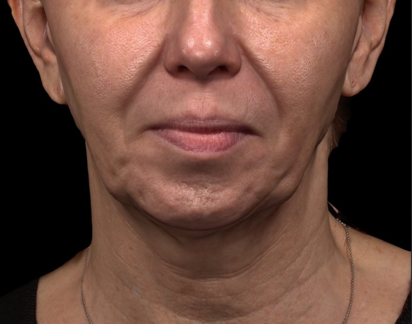 Dermal Fillers In Lower Face Before And After Photos Rejuva Center 