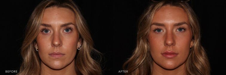 This is a side by side before/after frontal view image of a 26 year old beautiful woman, the image on the left shows her natural lips and the image on the right shows lips with more volume and structure.