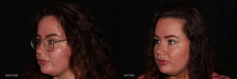 This is a before & after image of a young lady with brunette hair, with glasses on, looking at a 45 degree angle towards the left. The image on the left shows her natural lips and the image on the right shows a fuller lip after a lip injection.