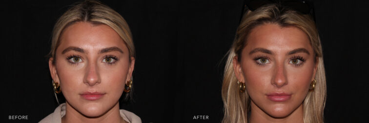 Side by side before and after of a young blonde woman's face taken from the front angle before and after lip filler. Before filler her lips were symmetrical but had added room for fullness and height. After filler her bottom lip is more plump and her top lip has additional height and fullness. | Albany, Latham, Saratoga NY, MedSpa