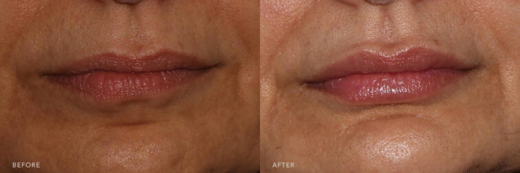 Before and after photo of a woman's lips from the front angle before and after lip filler. Before filler her lips were small and asymmetrical from both top to bottom and side to side. After filler her lips are more plump and full along with more symmetrical. | Albany, Latham, Saratoga NY, MedSpa