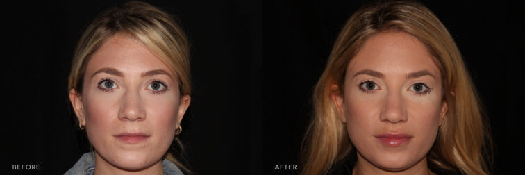 Before and after photo of a young blonde woman's face before and after lip filler. Before filler her lips were small and dry looking. After filler they look hydrated and subtly larger than before. | Albany, Latham, Saratoga NY, MedSpa