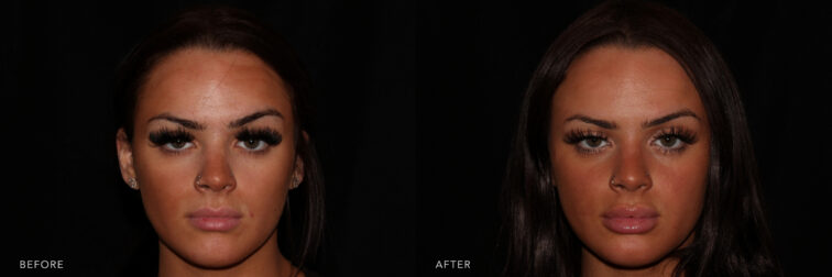 Side by side before and after of a brunette young woman's face taken from the front angle before lip filler. Before lip filler treatment her lips were full and symmetrical. After surgery her lips are very large and hydrated looking. | Albany, Latham, Saratoga NY, MedSpa