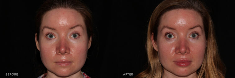 Side by side before and after of a middle aged blonde woman's face taken from the front angle before and after lip filler. Before filler her lips were small and thin. After filler they are plump, even, and proportionate to her face. | Albany, Latham, Saratoga NY, MedSpa