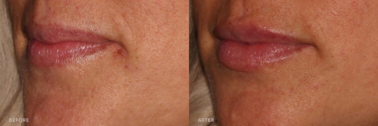 Before and after of a woman's lips from the oblique angle very close up. Before lip filler her lips had a good shape and volume. After filler her lips are a little bit bigger and are much more hydrated. | Albany, Latham, Saratoga NY, MedSpa