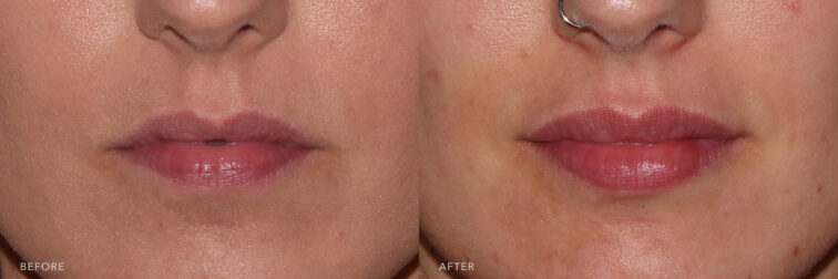 Before and after photo of a woman's lips before and after lip filler. Before filler her lips were full with room for added height and fullness. After filler her top and bottom lip are full and more symmetrical to each other. | Albany, Latham, Saratoga NY, MedSpa